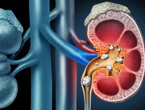 Kidney Stones Cure