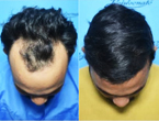 Hair Transplant