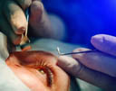 Cataract Surgery