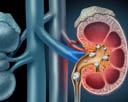 Kidney Stones Cure