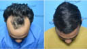 Hair Transplant