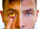 Jaundice Clinics